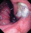Peptic ulcer disease